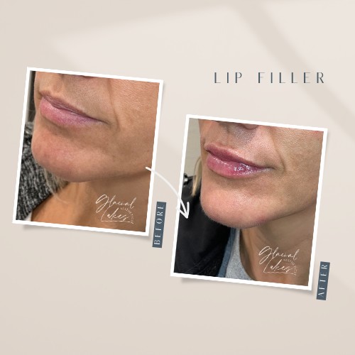 Before and after lip filler at Glacial Lakes Aesthetics in Spicer, Minnesota