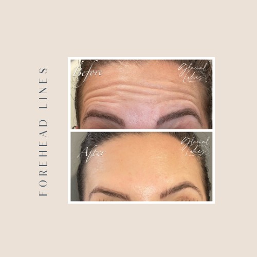 Before and after forehead lines at Glacial Lakes Aesthetics in Spicer, Minnesota
