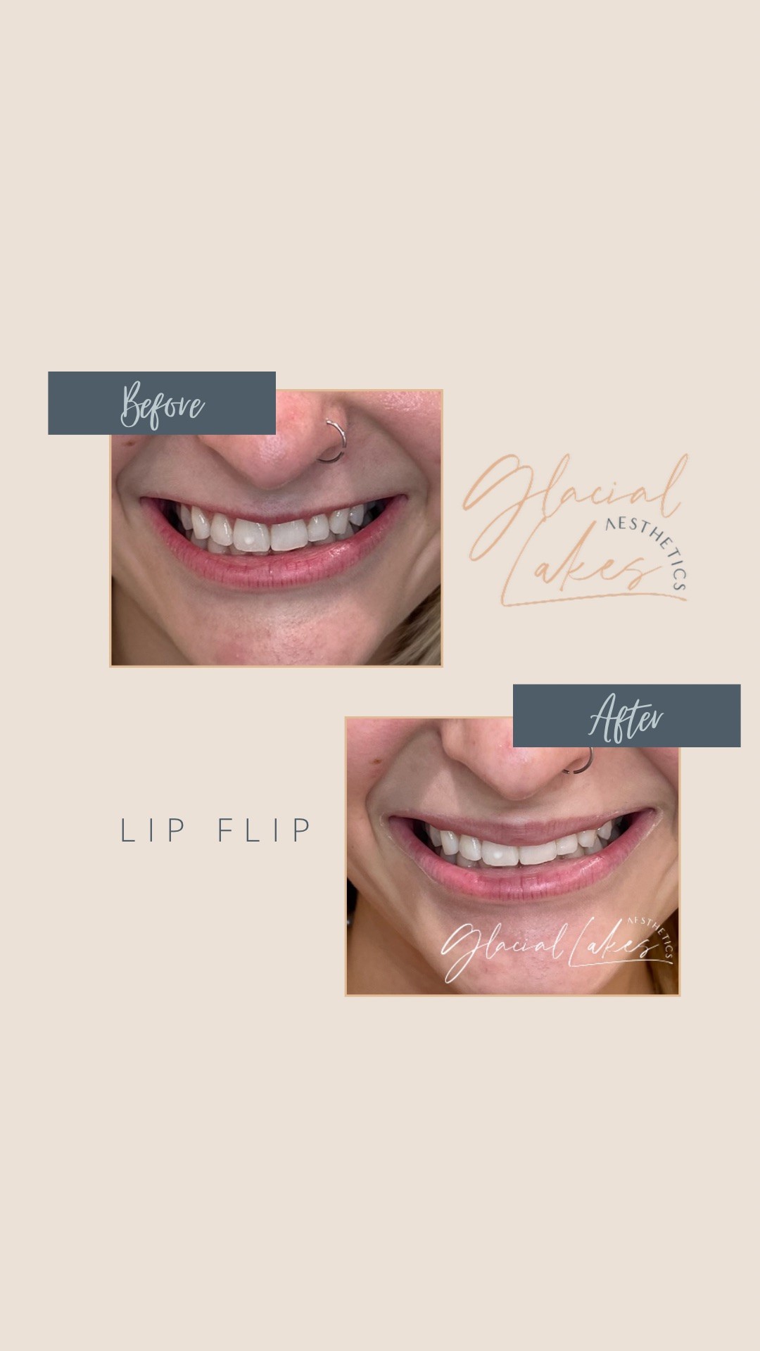 Before and after lip flip at Glacial Lakes Aesthetics in Spicer, Minnesota