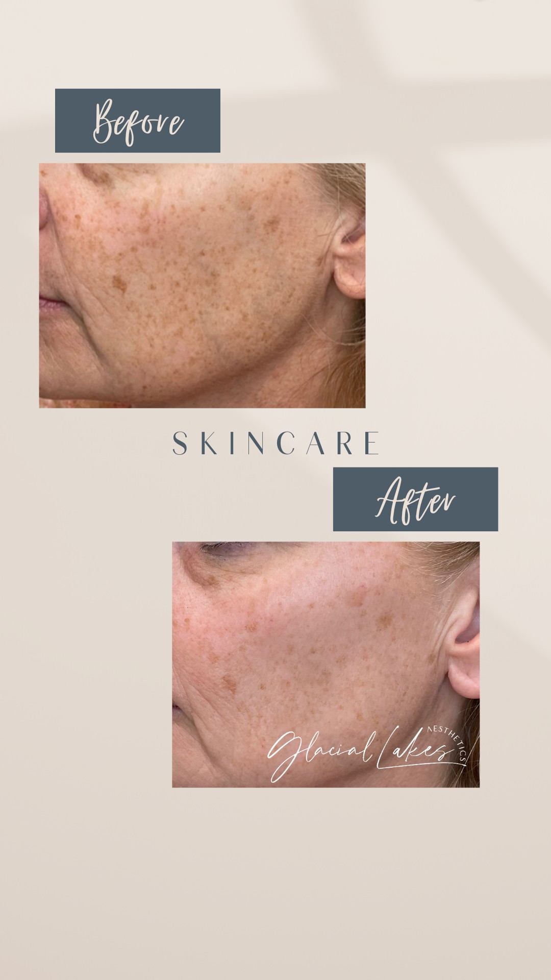 Before and after medical grade skincare at Glacial Lakes Aesthetics in Spicer, Minnesota