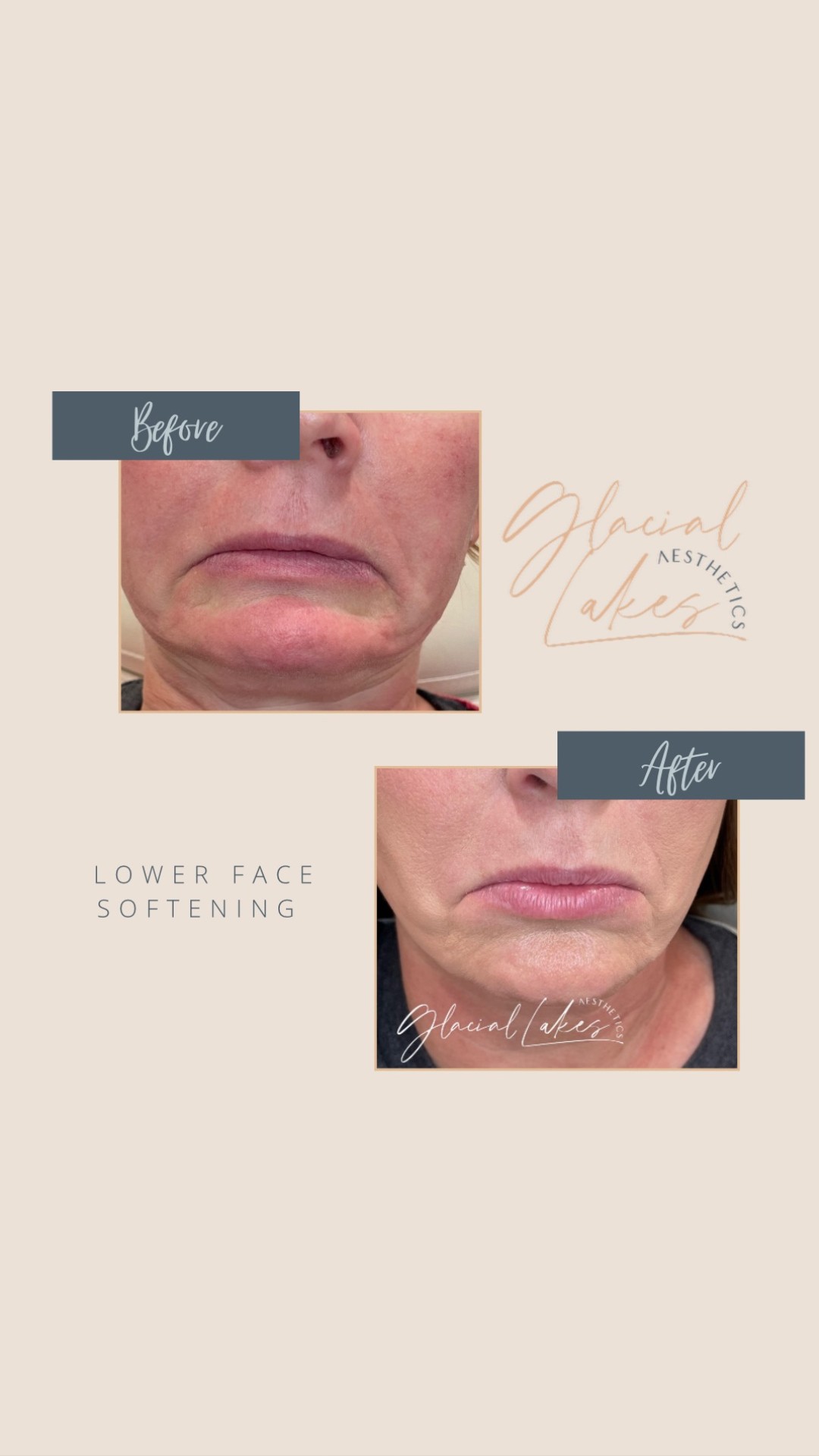 Before and after lower face softening at Glacial Lakes Aesthetics in Spicer, Minnesota