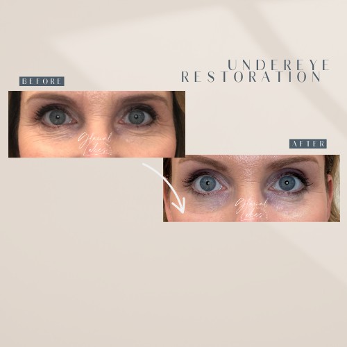 Before and after under eye restoration at Glacial Lakes Aesthetics in Spicer, Minnesota