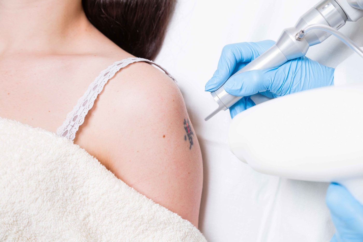 Tattoo removal at Glacial Lakes Aesthetics in Spicer, Minnesota