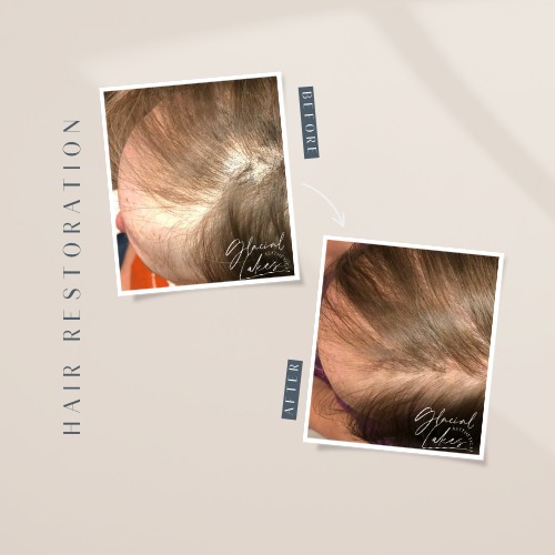 Before and after hair restoration at Glacial Lakes Aesthetics in Spicer, Minnesota