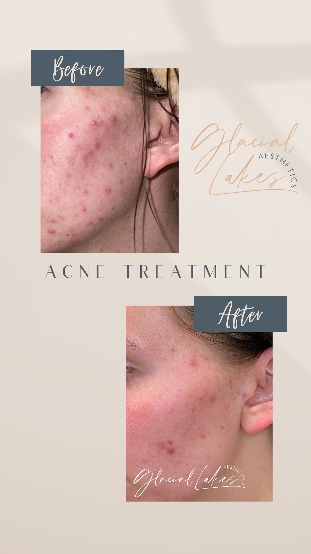 Before and after acne treatment at Glacial Lakes Aesthetics in Spicer, Minnesota