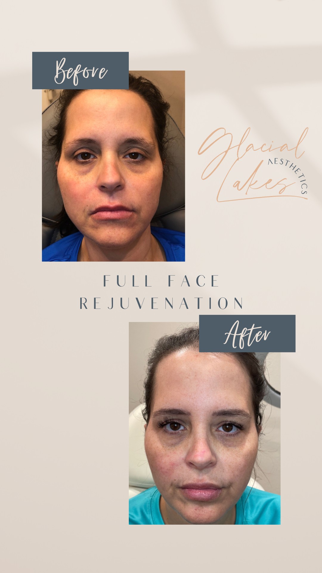 Before and after full face rejuvenation at Glacial Lakes Aesthetics in Spicer, Minnesota