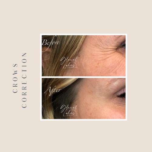 Before and after crow's feet correction at Glacial Lakes Aesthetics in Spicer, Minnesota
