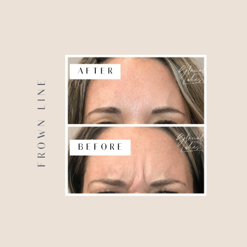Before and after frown line correction at Glacial Lakes Aesthetics in Spicer, Minnesota